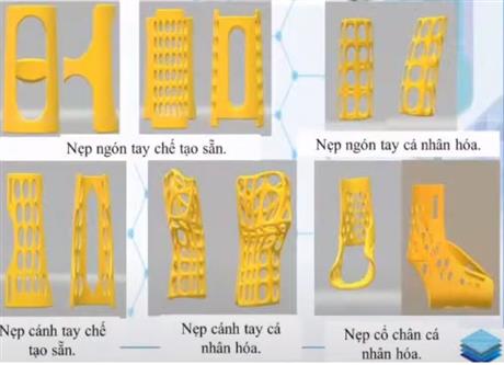 Công nghệ in 3D: Chế tạo nẹp chấn thương chỉnh hình